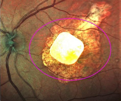 Implanted chip, natural eyesight coordinate vision in 